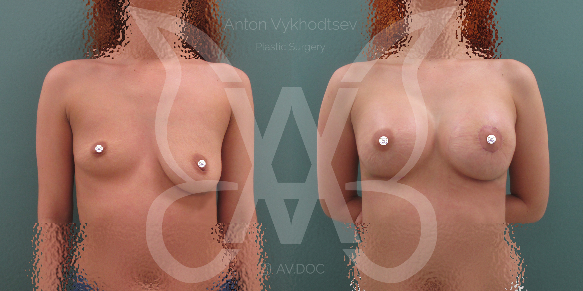 Увеличение груди + периареолярная мастопексия  — фото работ