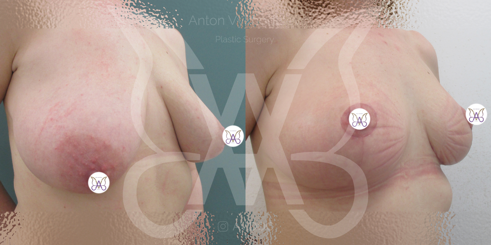 Подтяжка груди — инвертированный Т — фото работ