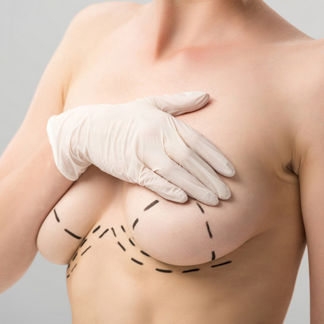 Показания к подтяжке груди