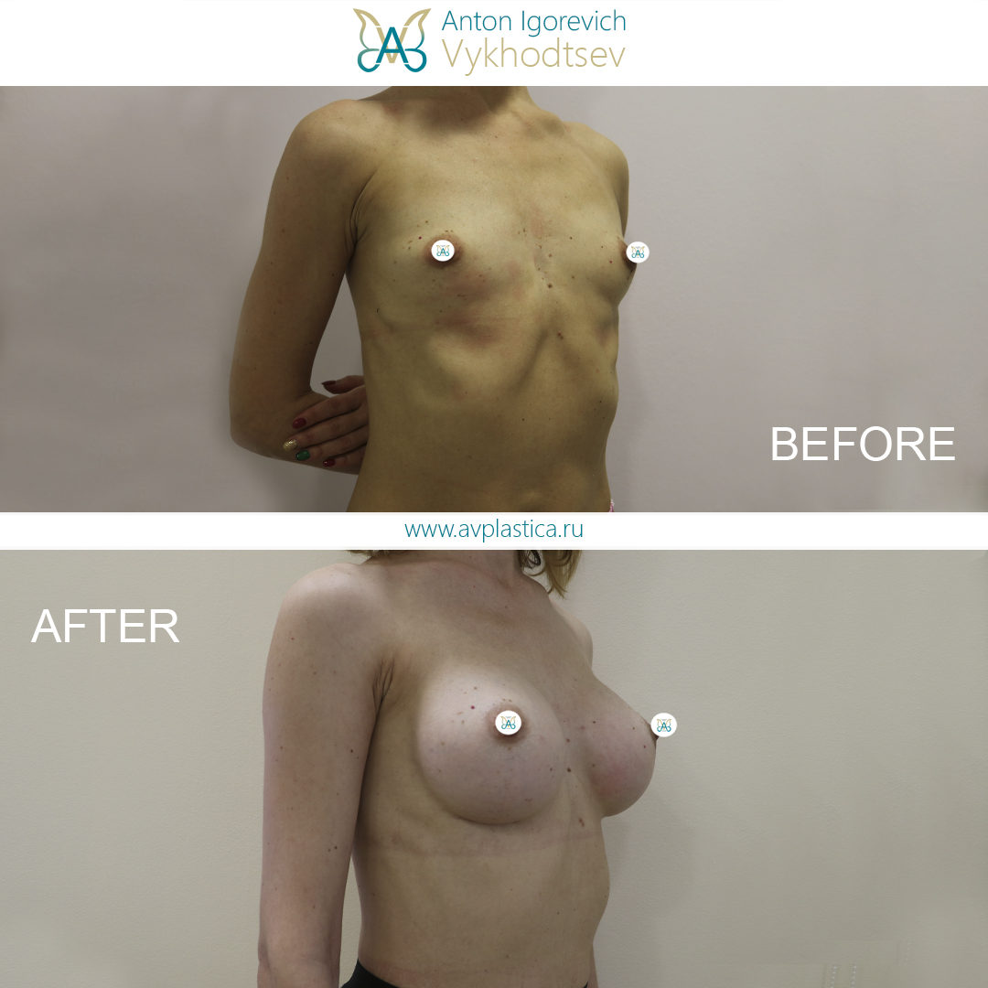 установка импланта груди видео (120) фото