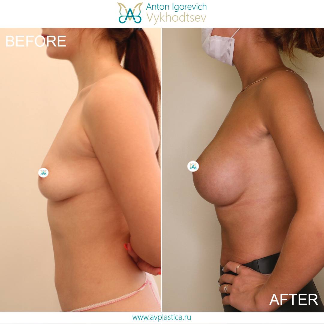 удаление импланта груди у женщин фото 65