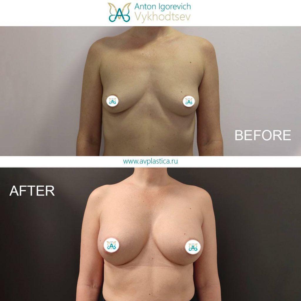 -->Увеличение груди анатомическими имплантами