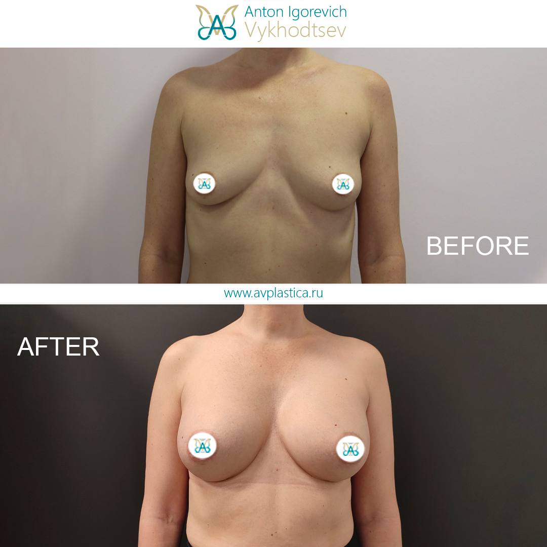 Увеличение груди анатомическими имплантами