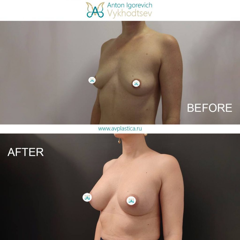 -->Увеличение груди имплантами