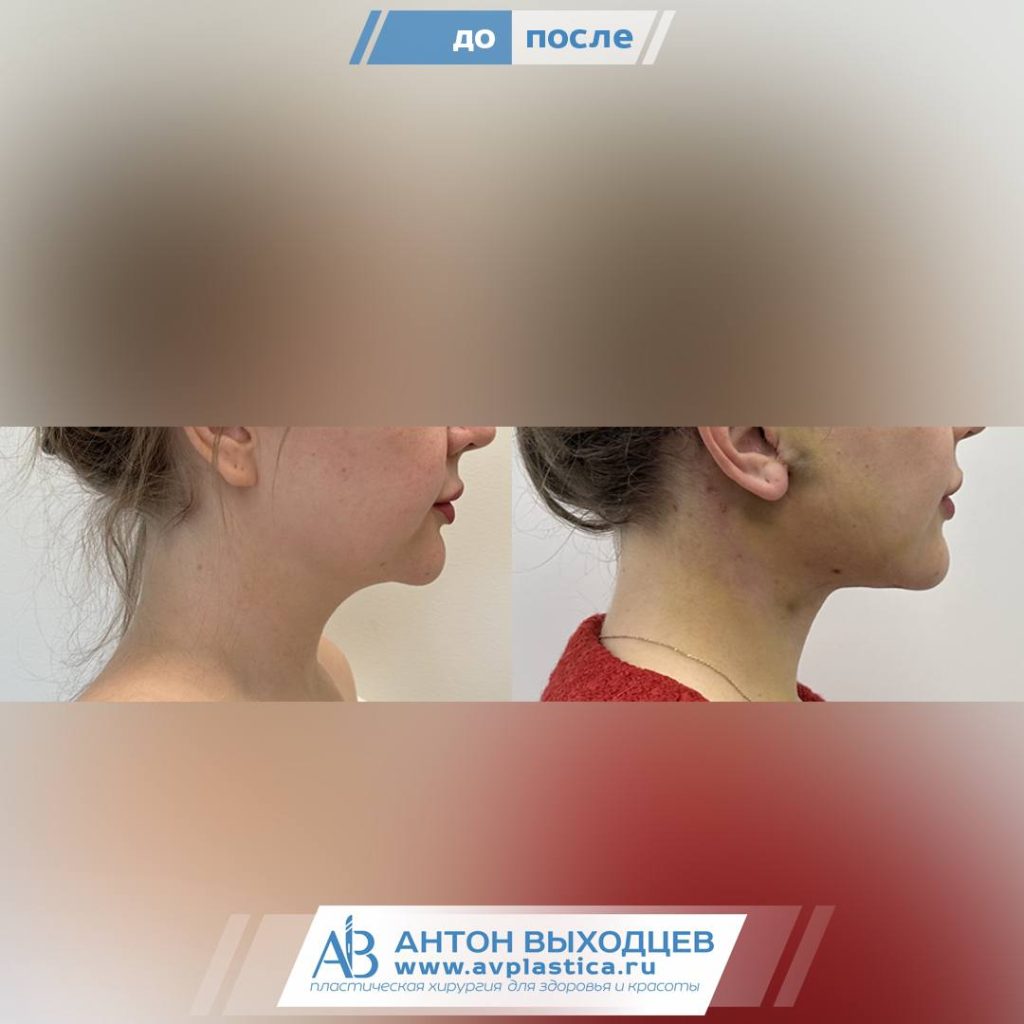 -->платизмопластика фото