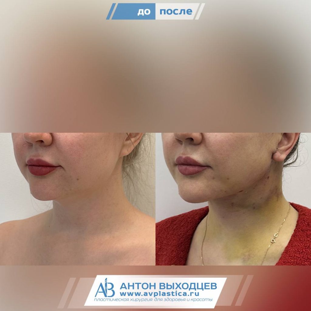 -->платизмопластика подтяжка шеи