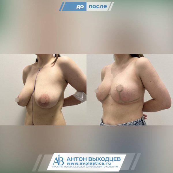 -->подтяжка груди без имплантов