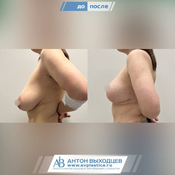-->якорная подтяжка
