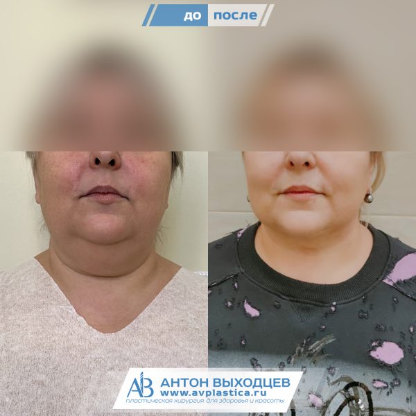 -->Липосакция подбородка