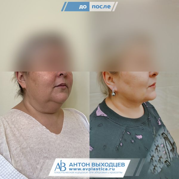 -->Липосакция шеи