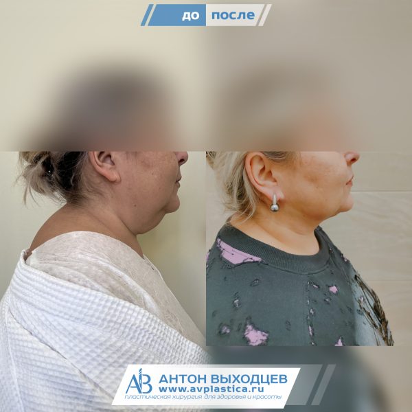 -->Липосакция второго подбородка