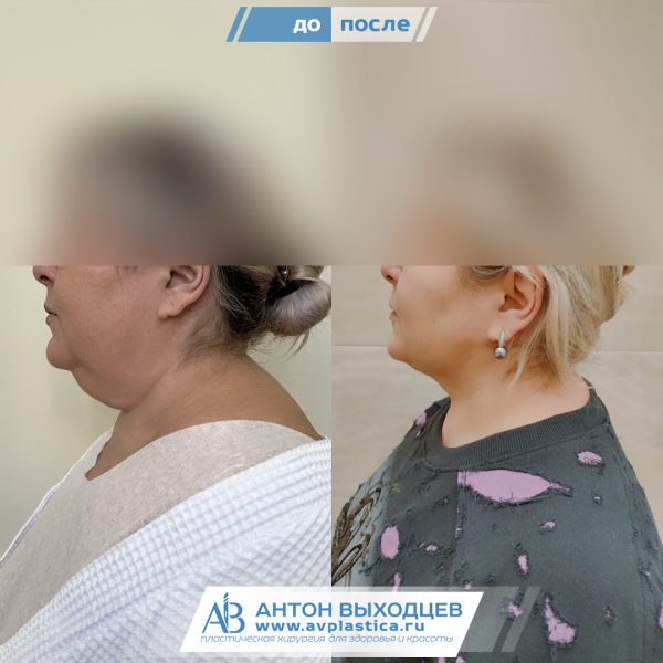 -->второй подбородок липосакция