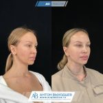 подтяжка лица (2)