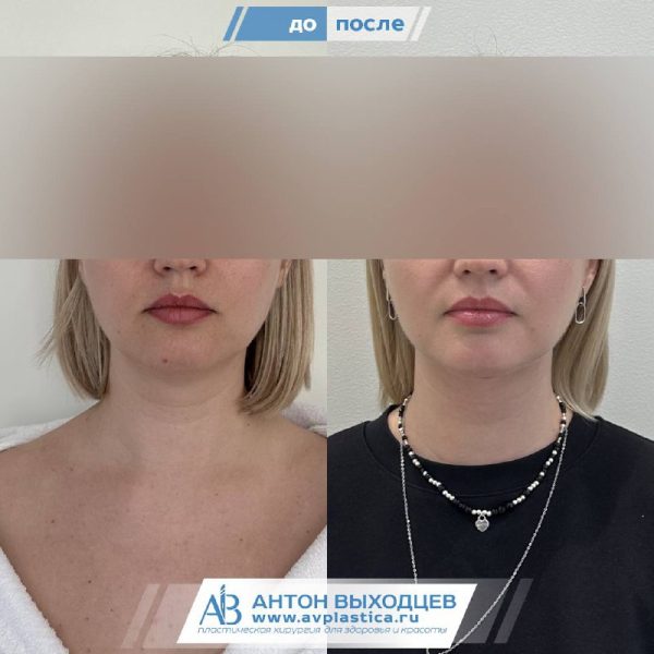 -->платизмопластика 3